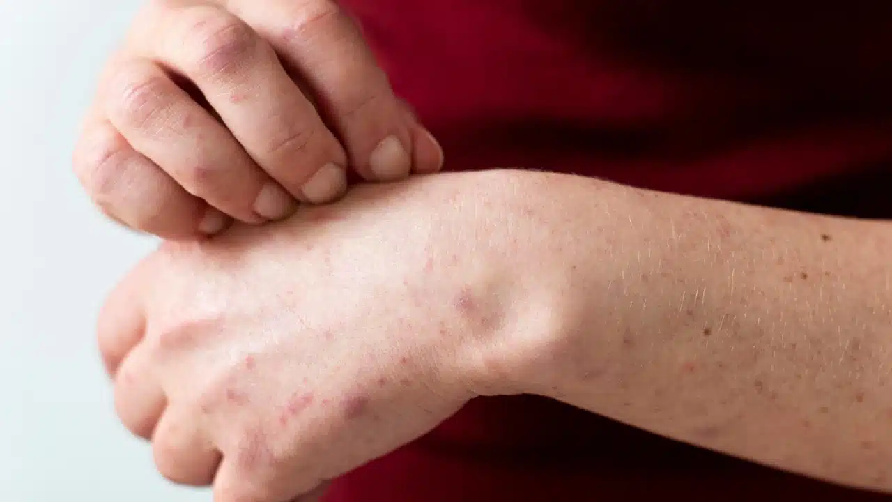 โรคฝีดาษลิง (Monkeypox) คืออะไร เกิดจากอะไร ลักษณะและวิธีรักษาโรคฝีดาษลิง