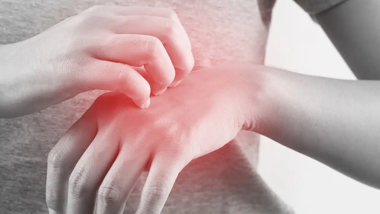 โรคลมพิษ (Urticaria) สาเหตุ อาการเป็นอย่างไร วิธีรักษาให้หายไวที่สุด