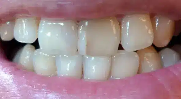 อาการปวดฟัน รู้เท่าทันสาเหตุเพื่อแก้ปวดฟันให้ทันก่อนจะสาย (เกินแก้!) 2566 -  Biocian